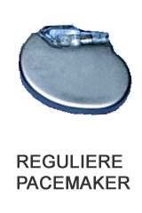 Reguliere pacemaker