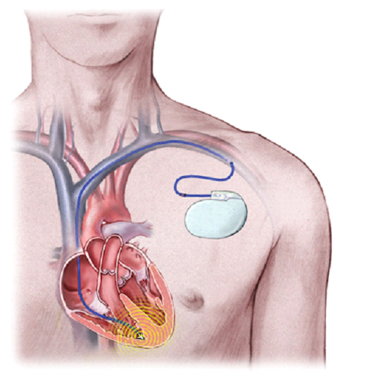 Tekening plaatsing pacemaker